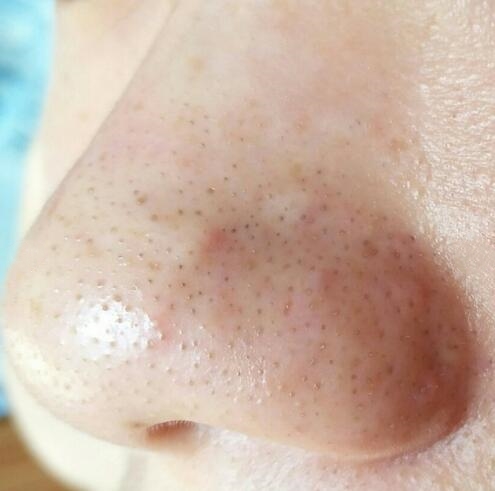 鼻子黑头小颗粒怎么去除,鼻子反复长黑头挤完都是坑