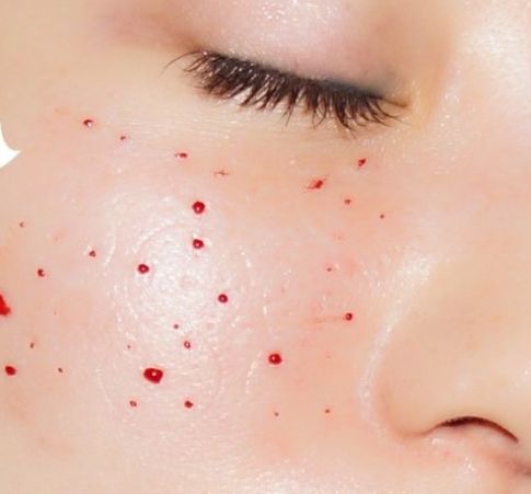 涂抹式水光和机打水光针哪种好,水光针风靡你必须知道的四个真相