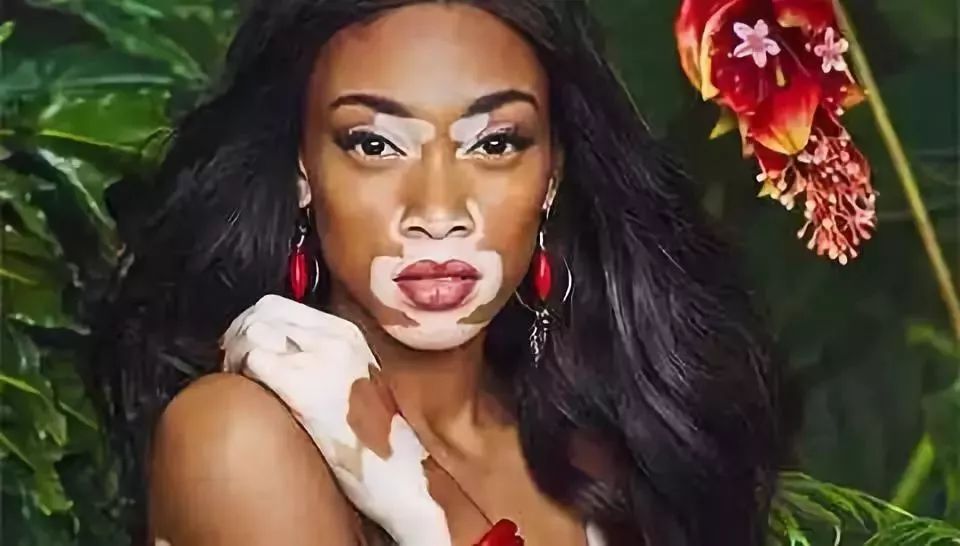 白癜风直播现场,白癜风治疗效果不明显