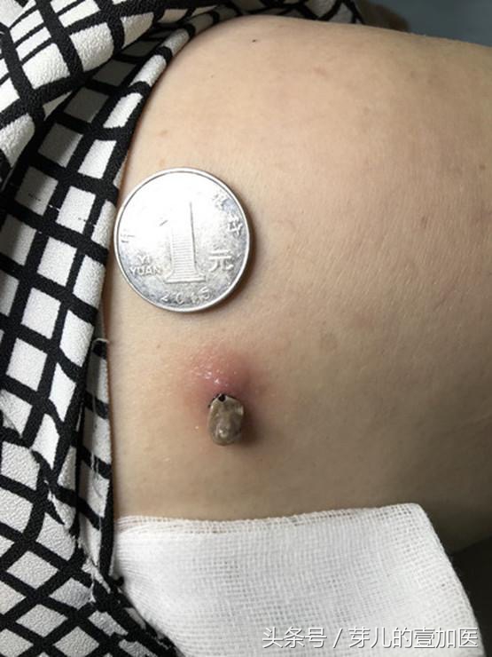 出去郊游如何避免蜱虫,小小蜱虫为什么毒性那么大