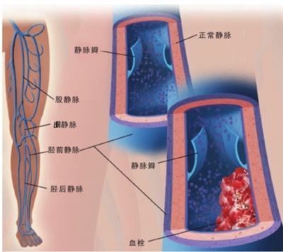 孕妇腿疼未必是缺钙,若忽视它可能会有致命风险