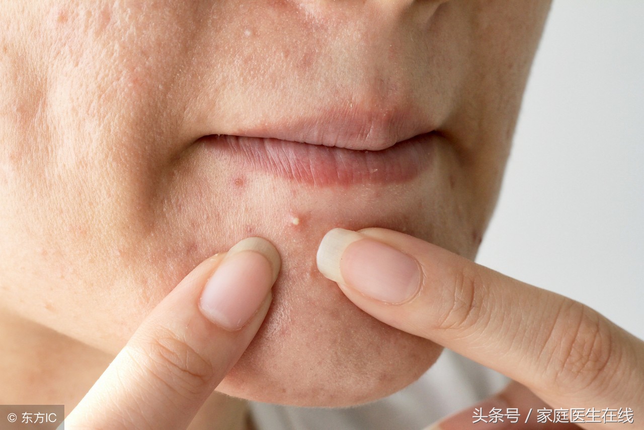 经常长痘的人怎么祛除痘痘,经常长痘该怎么办有效快速祛痘