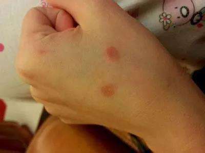 人感染了猫癣怎样治疗,人感染猫癣怎么治疗好得快