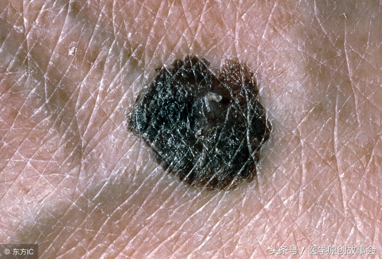 一旦皮肤上长了这种痣，十有八九是黑色素瘤，一拖再拖会很麻烦