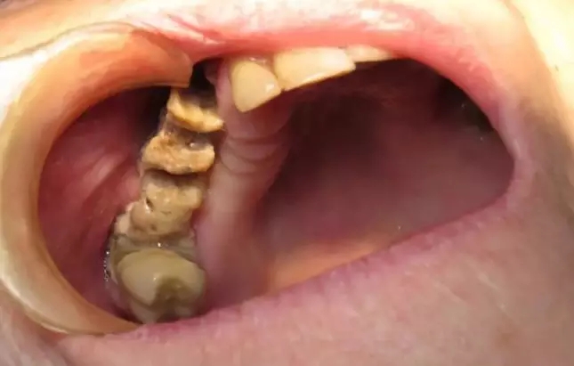 服用双膦酸盐类药物拔牙,双膦酸盐用药期间拔牙的危害