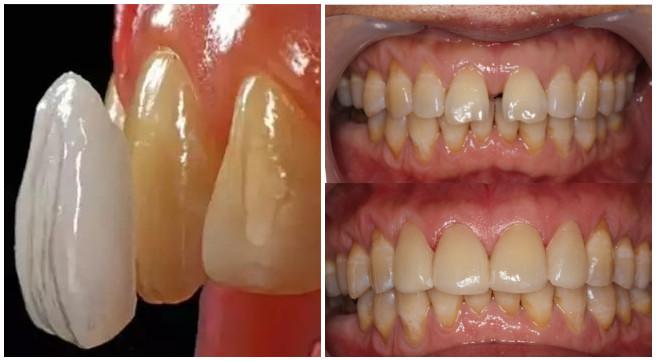 怎么缩小门牙牙缝,门牙牙缝怎么修复最简单方法