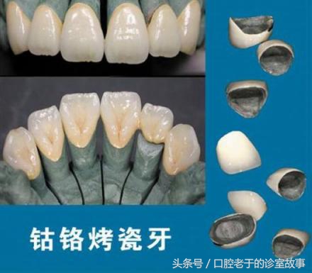 大部分人选择哪种烤瓷冠,一颗全烤瓷冠多少钱