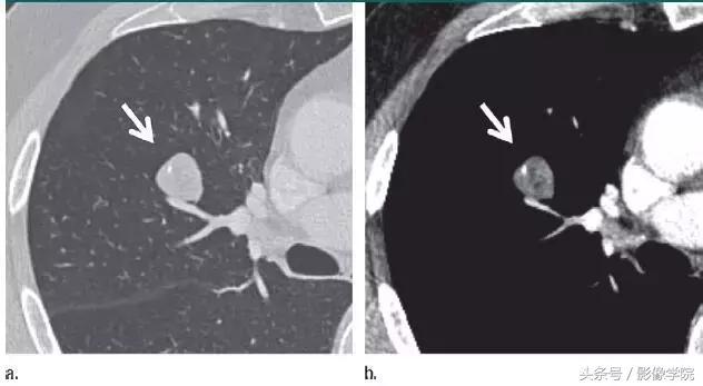 肺结节14种影像,一百例有结果的肺结节影像分析