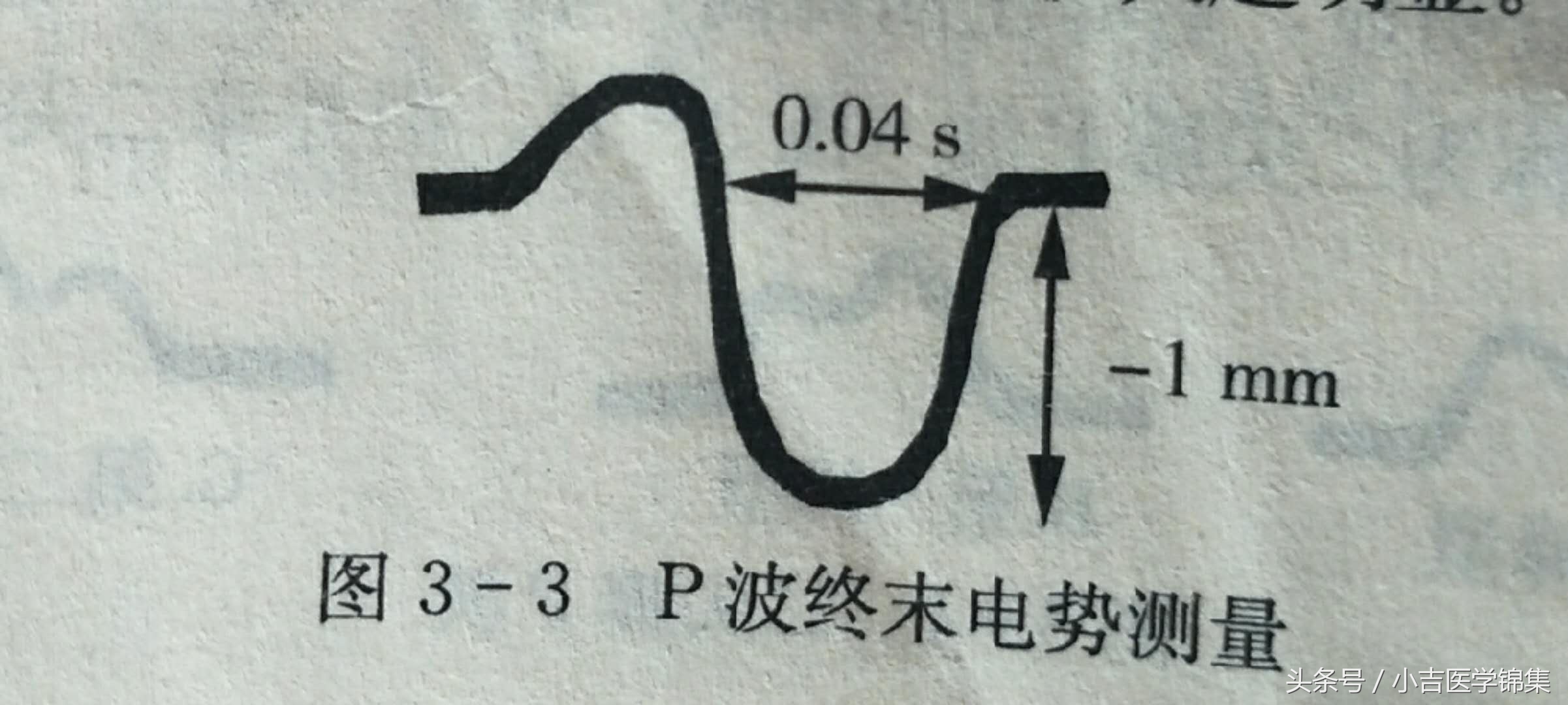 心房心室肥大,房室肥大要紧吗