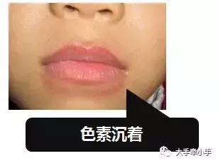 牙齿不齐矫正好还是做牙冠好,牙齿不齐矫正1个月的变化