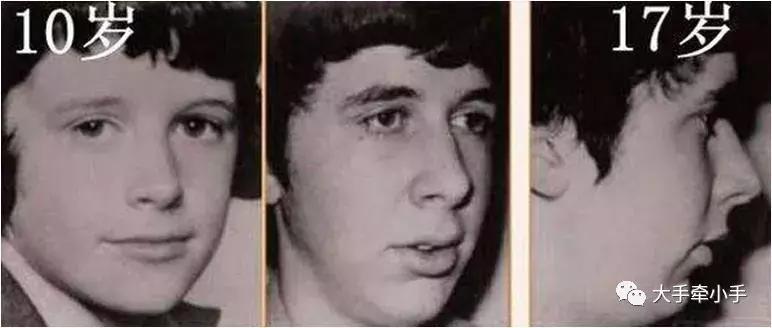 牙齿不齐矫正好还是做牙冠好,牙齿不齐矫正1个月的变化