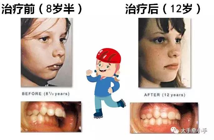 牙齿不齐矫正好还是做牙冠好,牙齿不齐矫正1个月的变化