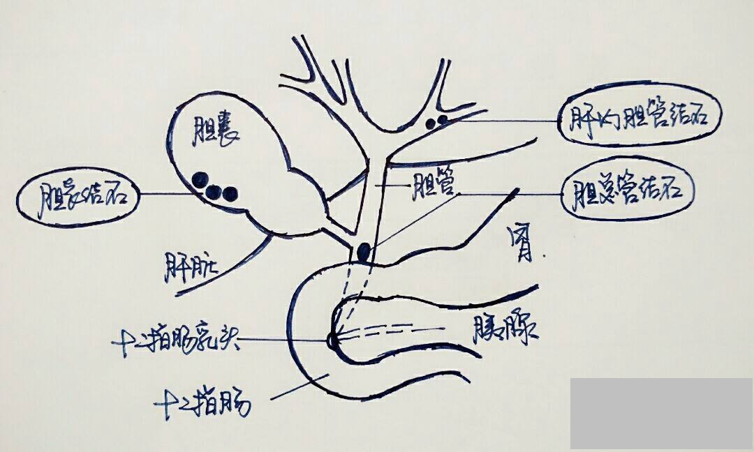 胆结石43mm算大吗怎样预防,胆囊切除术后怎么预防胆结石