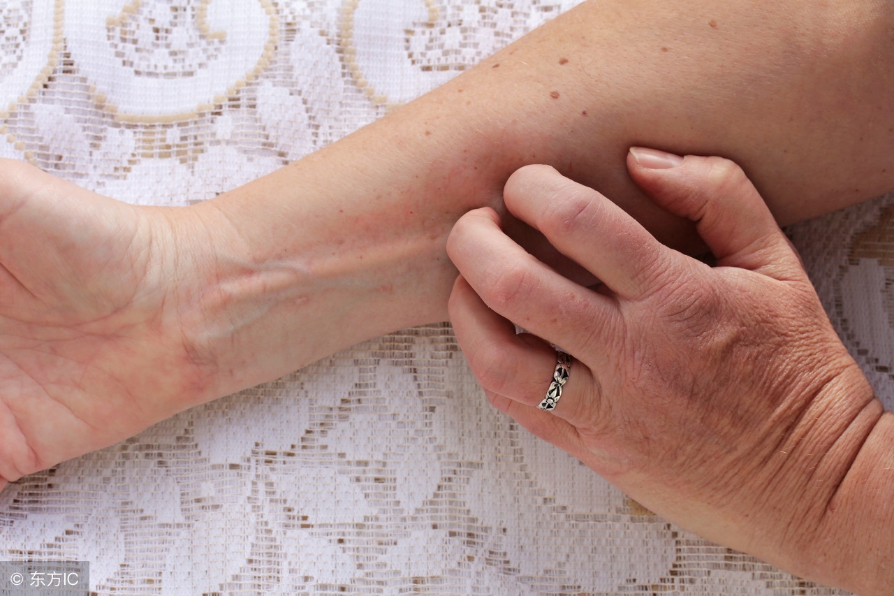 手部干性湿疹和角化湿疹,手部湿疹和脚底湿疹