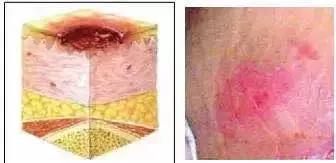 压疮预防指南推荐,压疮的治疗最新进展ppt