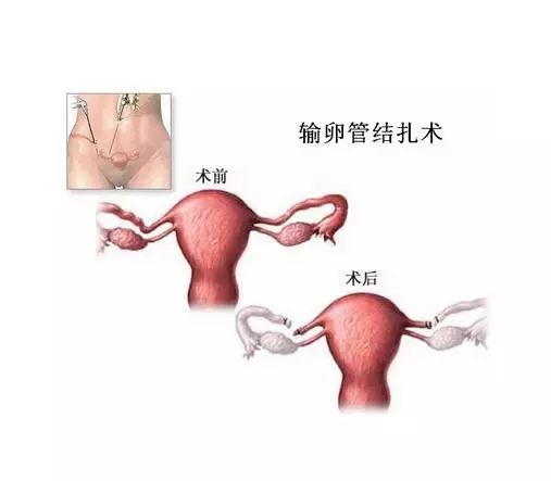 老公愿意去结扎说明什么,想做结扎的手术