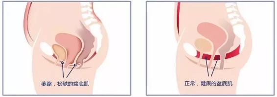 新妈注意！便秘、漏尿、XXOO不谐……产后这些尴尬都是因为它