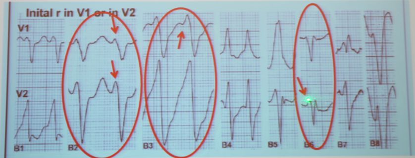 「CHC2018」郭继鸿：心电学进展2018