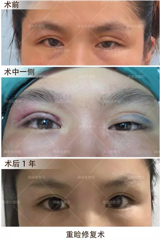 双眼皮刚割完不对称后来好了,全切双眼皮拆线后不对称