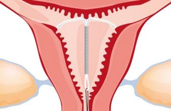 产后要不要绑腹带,产后要不要绑骨盆带呢