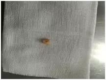 反复喘息呼吸急促,反复或持续性喘息