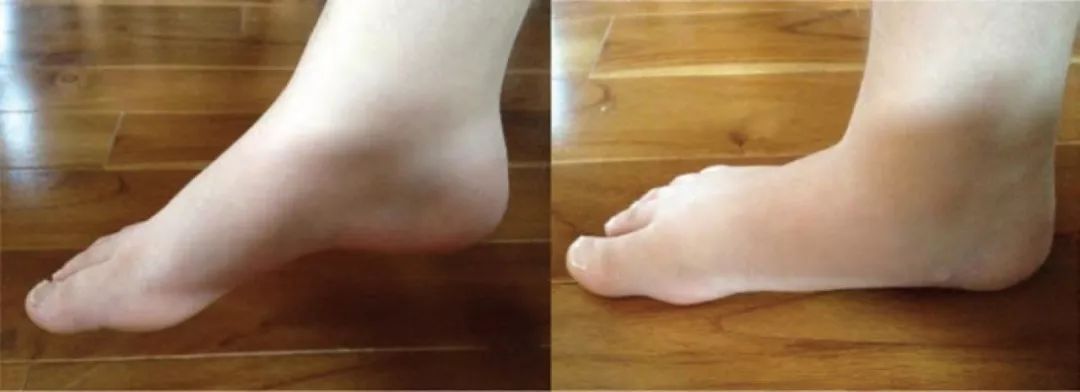 儿童扁平足矫正方法,儿童扁平足不治疗会怎么样