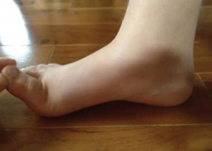 儿童扁平足矫正,儿童轻微扁平足还需要穿矫正鞋吗