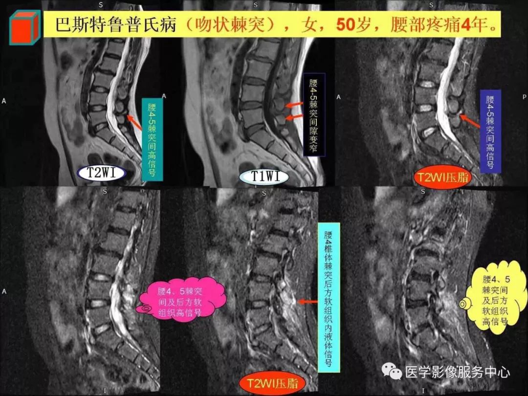 腰痛患者常用的特殊检查方法,腰痛影像诊断
