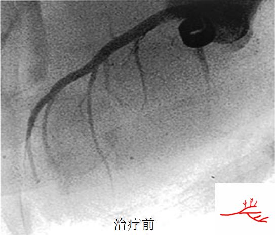 体外心脏震波治疗费用,北京医院介入治疗微创中心