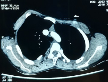 重度漏斗胸手术怎么做,胸廓畸形导致缺氧能做手术吗