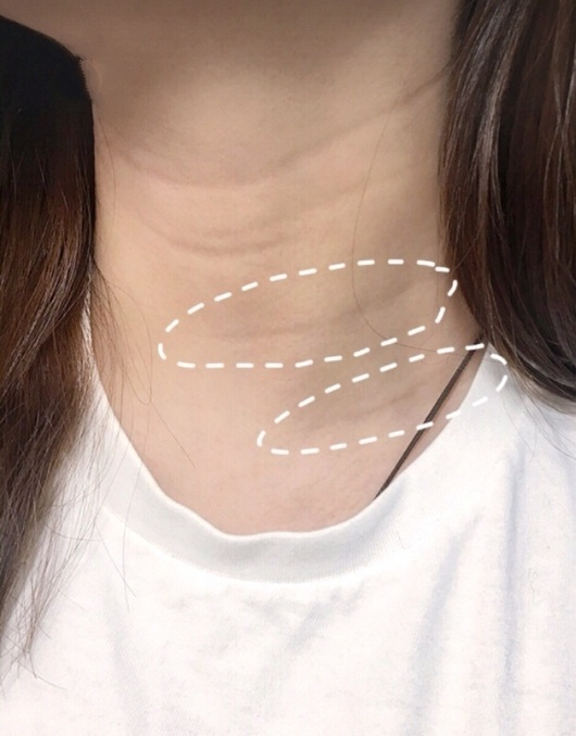 十几岁就有很深的几道颈纹,十几岁很深的颈纹怎么办