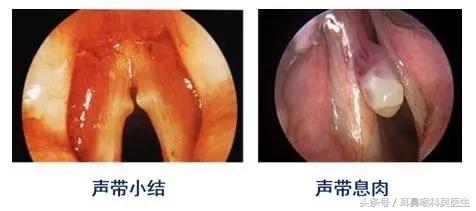 嗓子哑了怎么办小学生,嗓子哑了怎么办女生