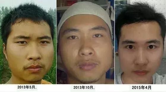 手淫3年，面貌早衰——戒手淫2年后改变！