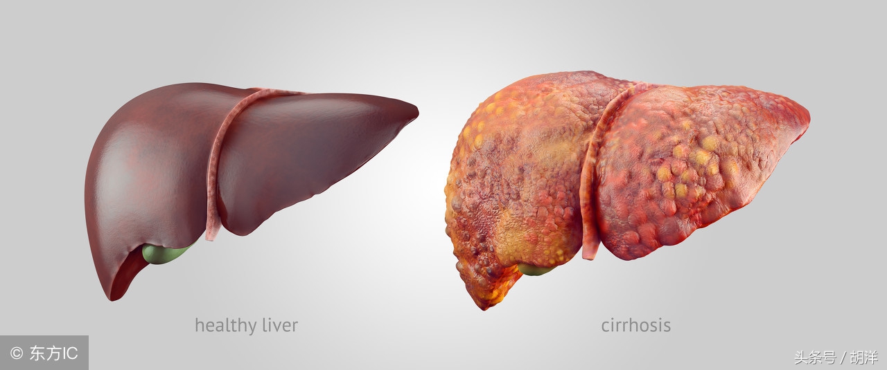 肝性胸腔积液症状怎么调理,肾脏引起的胸腔积液怎么治疗