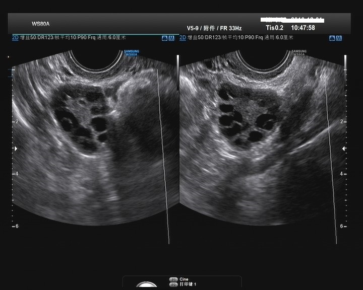 月经规律备孕失败的原因,月经不正常备孕发现问题