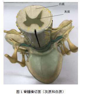 高位截瘫小便有感觉吗,高位截瘫病人取了尿管能尿出来吗