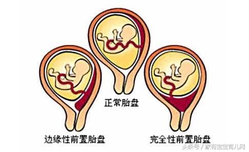 孕期阴道出血有什么症状,孕期阴道出血有哪些症状