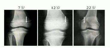 骨骺闭合真的没有可能长高了吗,骨骺闭合后怎么才能长高
