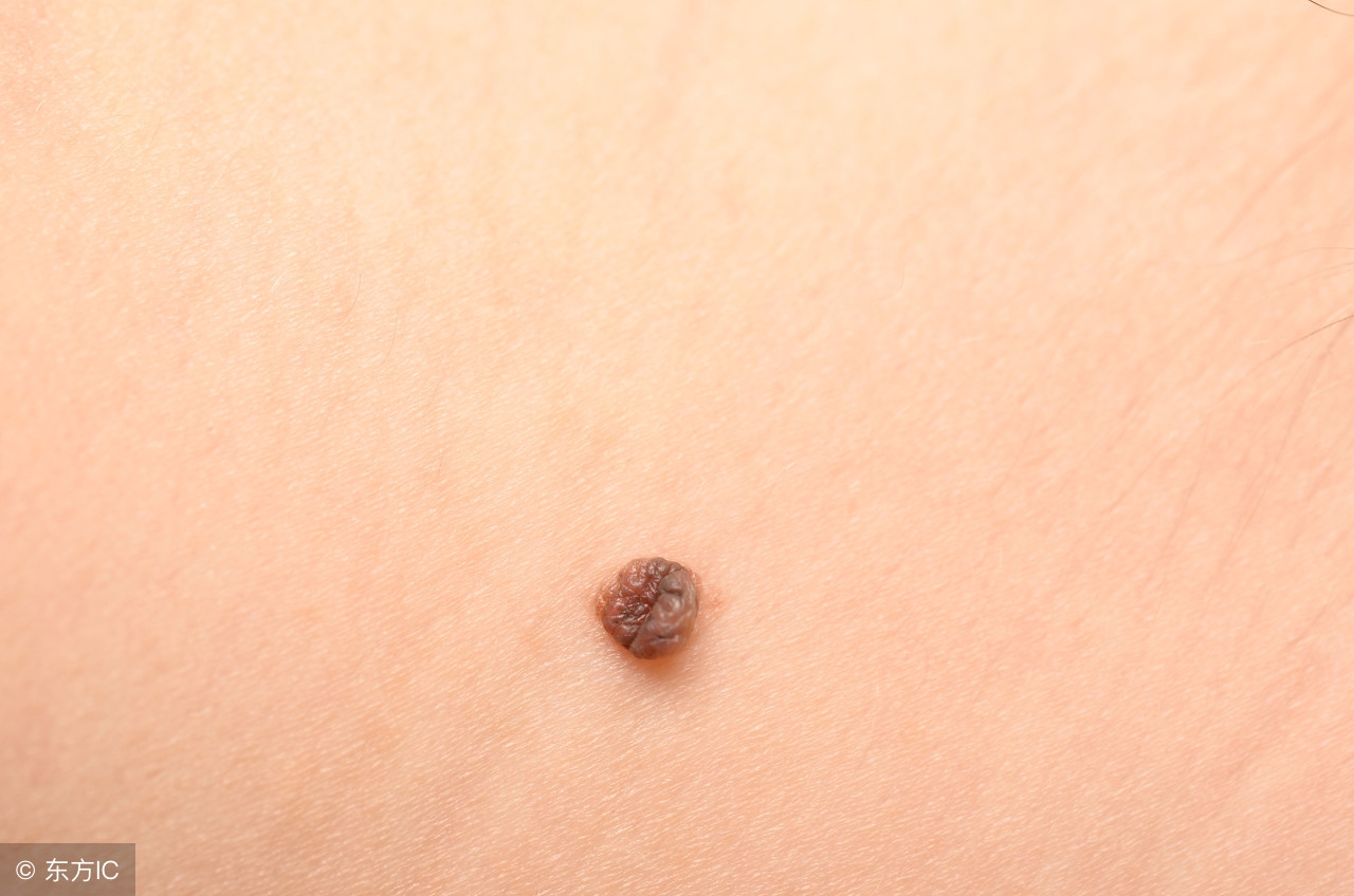身上黑色素痣越来越多是怎么回事,黑色素痣患者全身出现好多黑痣