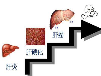 肝炎发作时肝区什么变化,肝炎导致肝损伤的症状与治疗