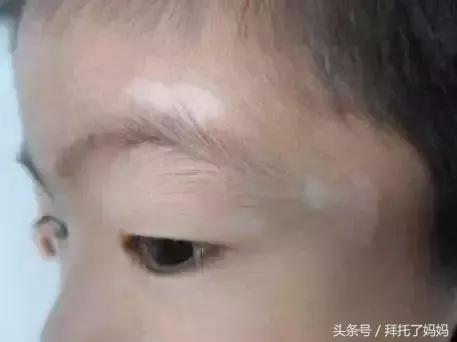 宝宝六个月有虫子了怎么办,八个月宝宝眼睛取出虫子