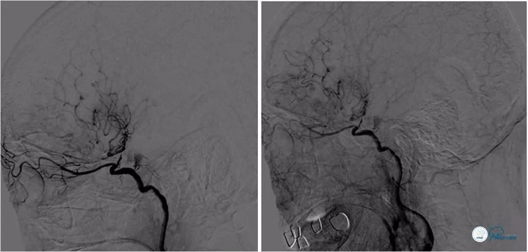颈内动脉c5到c7段狭窄微创手术,天坛医院住院日记