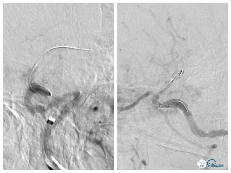 颈内动脉c5到c7段狭窄微创手术,天坛医院住院日记