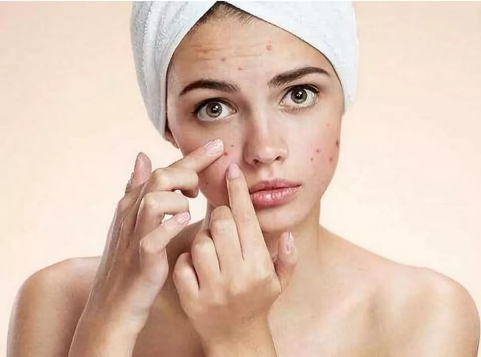 青春痘疤痕消除的药膏,青春痘疤痕图