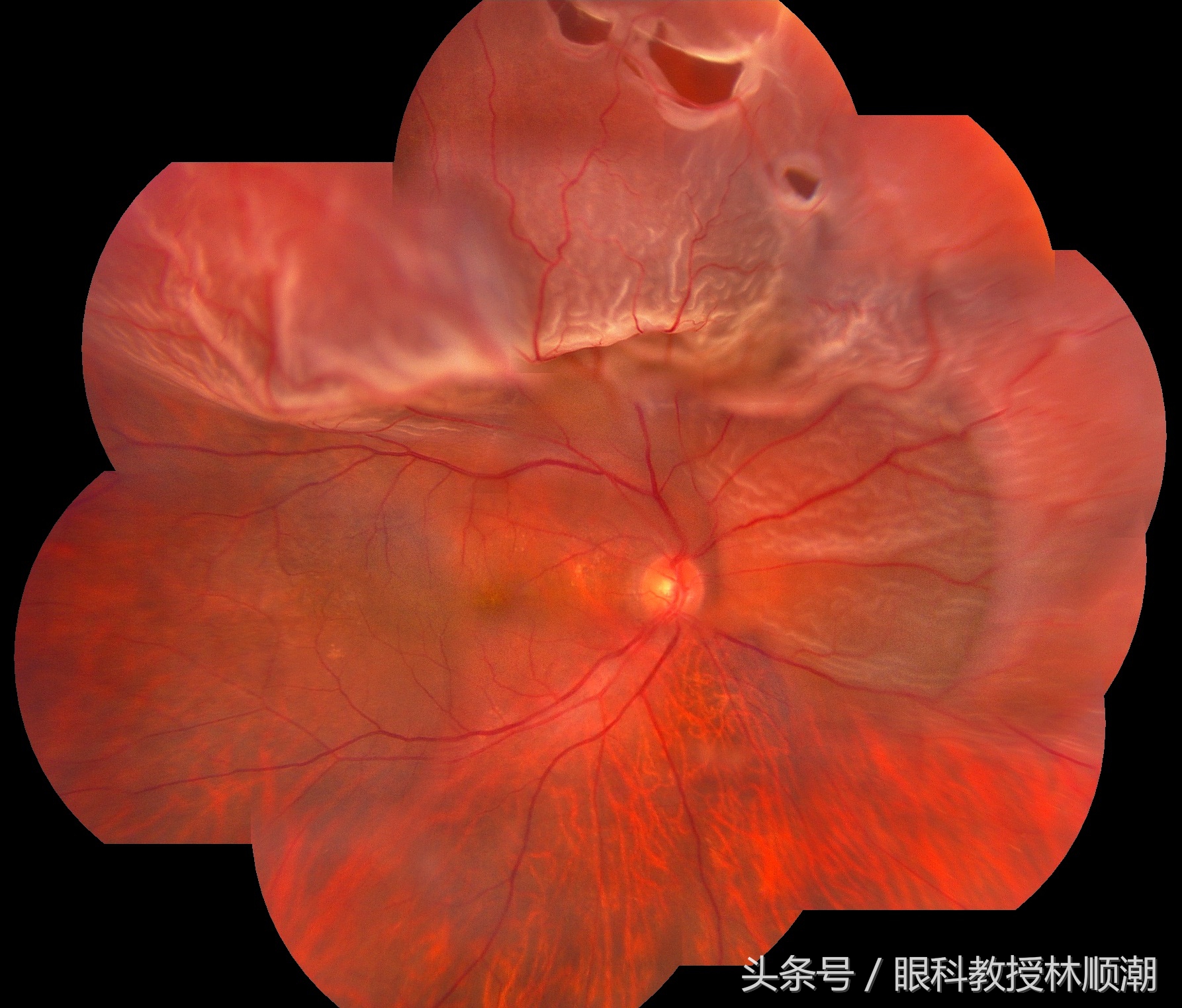 眼睛有飞蚊会导致视网膜脱落吗,有飞蚊症还闪光是视网膜脱落吗