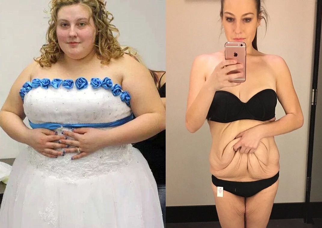 瘦了200斤，身体很多赘皮，怎么办？