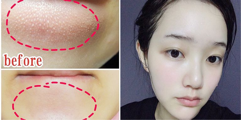 下巴处闭口粉刺怎么彻底去除,额头和下巴闭口性粉刺怎么办