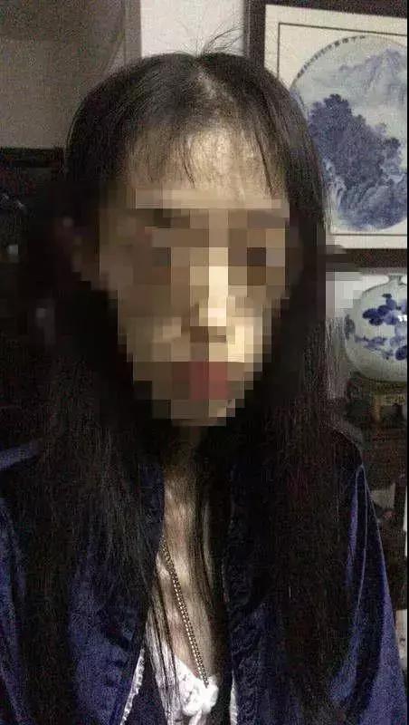 21岁女孩自杀式减肥只剩50斤，照片不忍直视…………