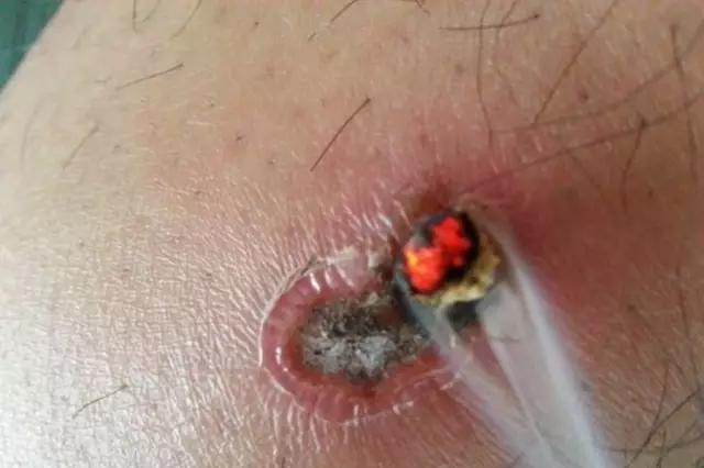 什么是熏灸,蒸敷灸原理