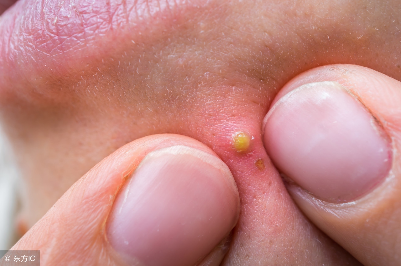 脸上长痘是五脏不健康！吃两物清热解毒，改善青春痘